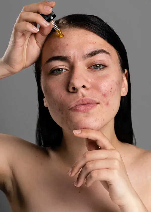 Transform Your Skin and Boost Your Confidence: The Best Products to Beat Hormonal Cystic Acne